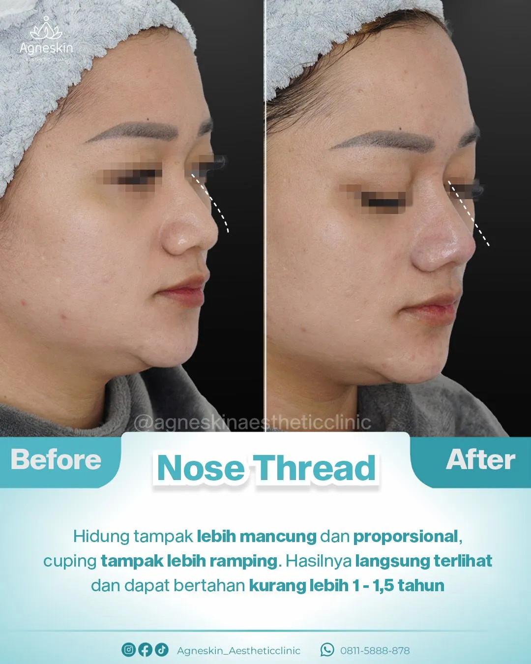 Before After Nose Thread